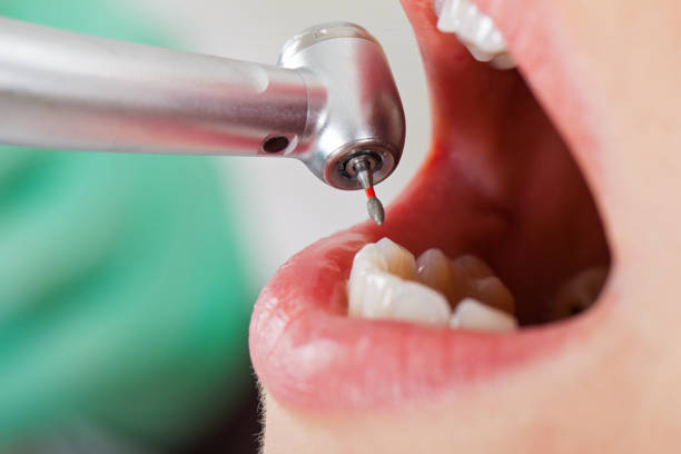 Best Emergency Dentist for Lost Fillings or Crowns in Clarksville, IA